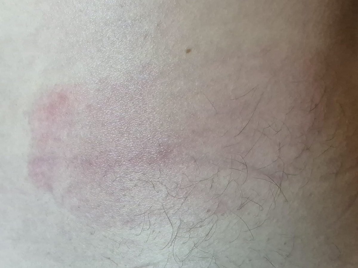 Remember last month when I found 3 ticks on me?
  Well I had one area that didn't have a tick attached, on my side.. but a red rash started spreading out around a mark/scratch/bite... I wasn't worried, it wasn't a 'bullseye', typical of Lyme Disease. I thought it must've been a