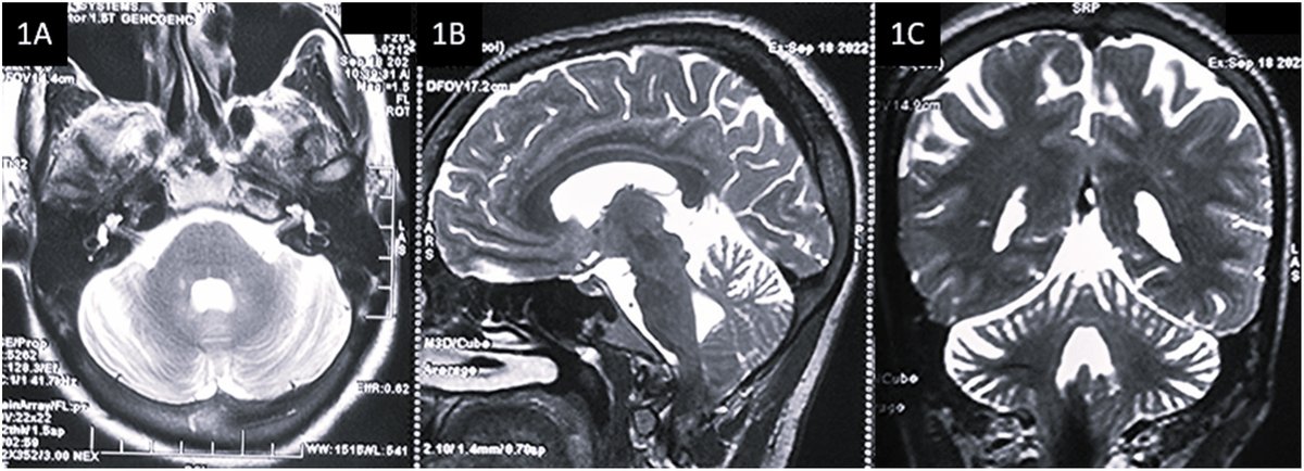 First Indian family of CPT1C-related Spastic-Ataxia: Expanding the clinical spectrum of SPG73 <a href="/ParkinsonismD/">Parkinsonism & Related Disorders</a>  
#CeramideMetabolism 
doi.org/10.1016/j.park…