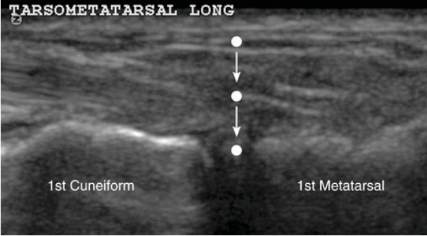 SportsMedReview's tweet photo. A lisfranc injection can be performed under ultrasound guidance in patients with certain types of lisfranc injuries or refractory pain in the midfoot/ forefoot! Click/ follow to learn more!

Read: https://t.co/pxQGcwkxXa

#sportsmedicine #physicaltherapy #physiotherapy #orthopedics #rehab #sportsinjury #injuryprevention #rehabilitation #athletictraining #meded