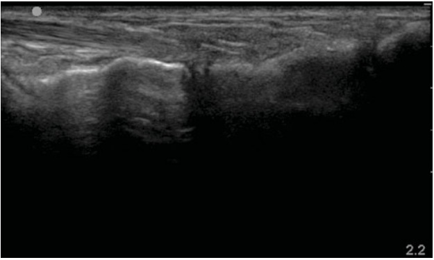 SportsMedReview's tweet photo. A lisfranc injection can be performed under ultrasound guidance in patients with certain types of lisfranc injuries or refractory pain in the midfoot/ forefoot! Click/ follow to learn more!

Read: https://t.co/pxQGcwkxXa

#sportsmedicine #physicaltherapy #physiotherapy #orthopedics #rehab #sportsinjury #injuryprevention #rehabilitation #athletictraining #meded
