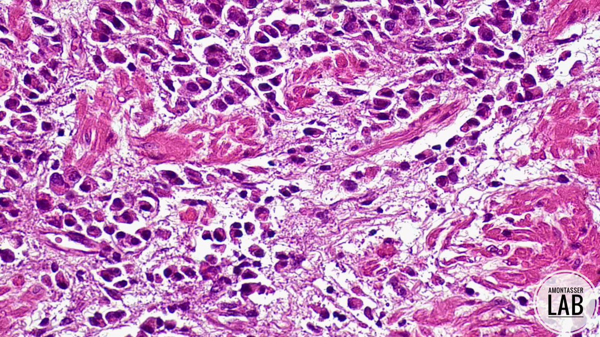 AMontasserMD's tweet image. Plasmacytoid urothelial carcinoma  🫒
