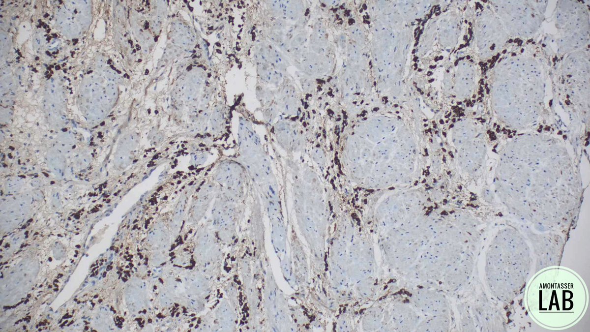 AMontasserMD's tweet image. Plasmacytoid urothelial carcinoma  🫒