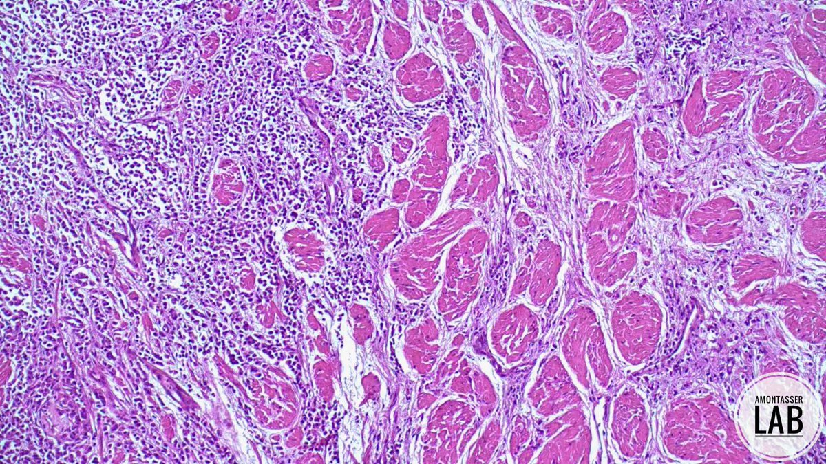 AMontasserMD's tweet image. Plasmacytoid urothelial carcinoma  🫒