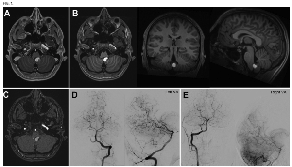 TheJNS's tweet image. #JNSCaseLessons. Researchers discuss diagnostic challenges and management approach in rare case of pediatric thrombosed aneurysm with neoplasm-like presentation.
thejns.org/caselessons/vi…