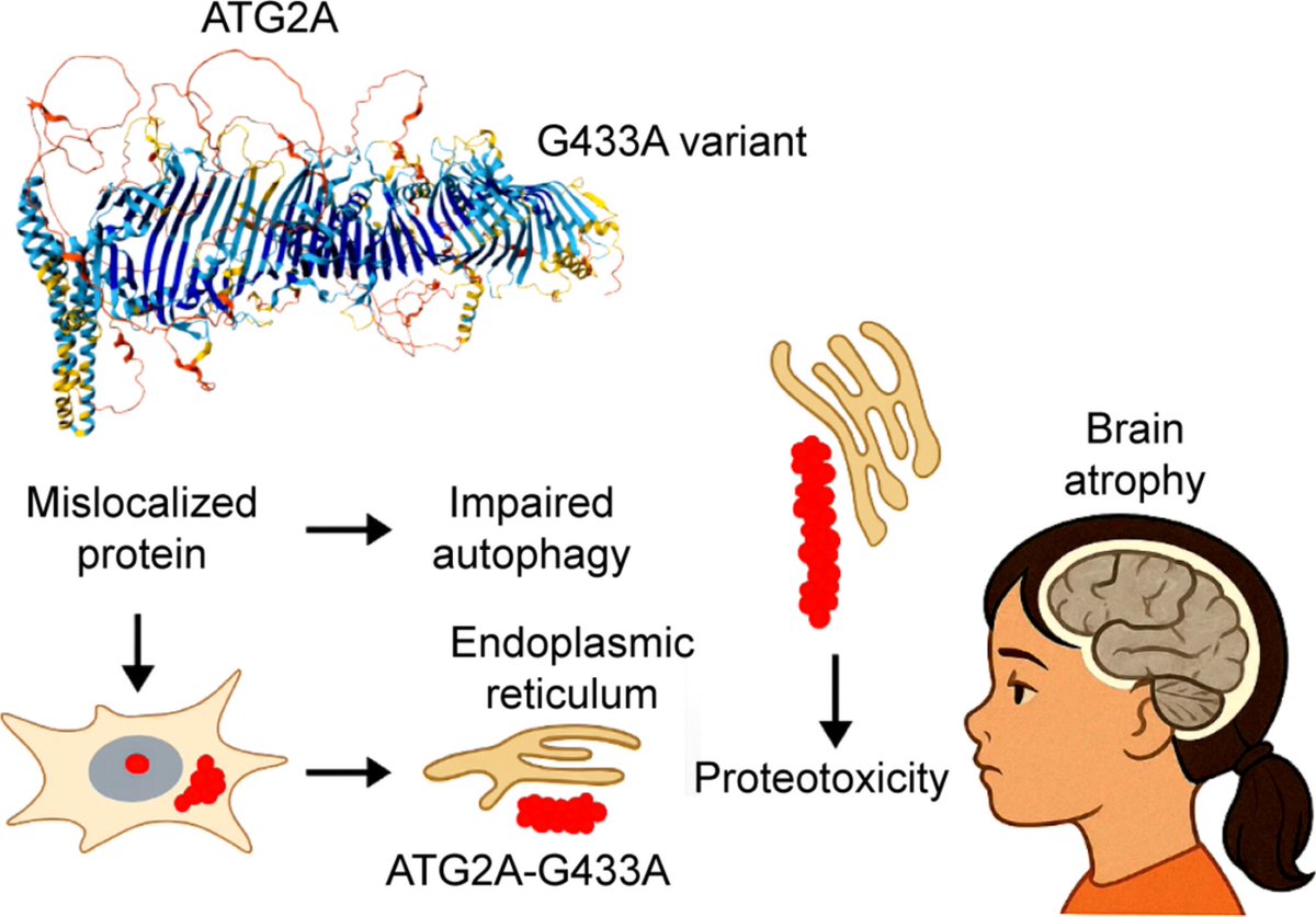 FranMartinezGr's tweet image. An Unstable ATG2A Variant Causes a Neurodegenerative Disorder via Impaired Autophagy and Proteotoxic Stress in Brain Atrophy #RareDisease #Genetics #morbidgene onlinelibrary.wiley.com/doi/10.1111/cg…