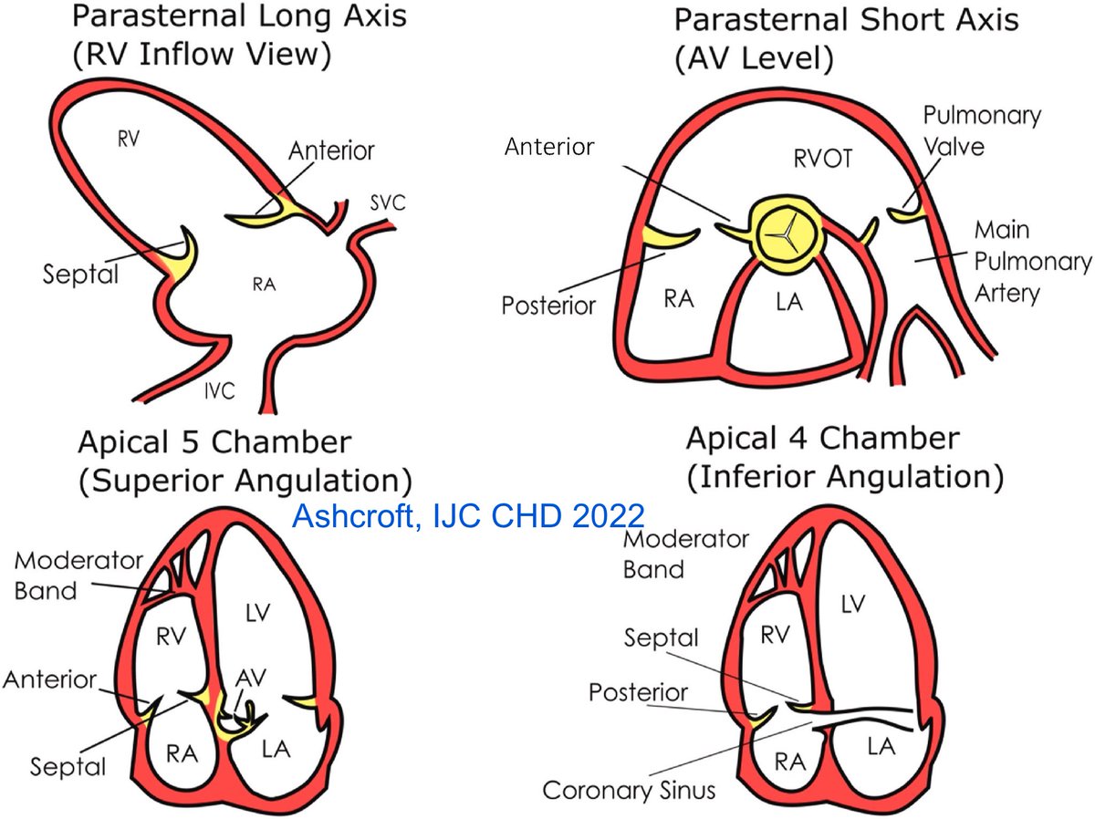 Bonus: What RV walls and Tricuspid leaflets are seen in the RV inflow view? 👇
#POCUS #FOAMed 
Also keep in mind that Doppler alignment with the TR jet may not be optimal in this view. Whenever possible, obtain measurements from multiple views.