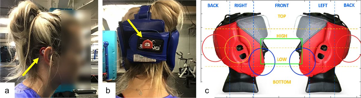 ABMEjournal's tweet image. Many head impact sensors used in sports may be giving misleading data about concussion risk.
A recent study investigated the reliability of three commonly used head impact sensors – instrumented mouthguards, skin patches, and headgear patches – during boxing sparring.…