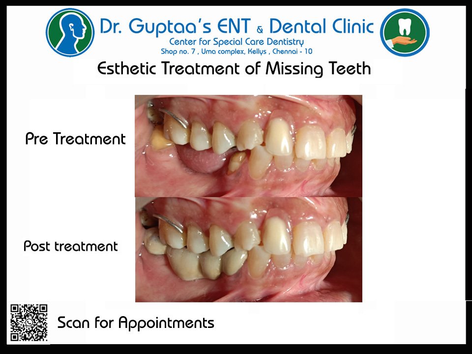 mogitygupta's tweet image. 🦷 Missing teeth are more than a gap in your smile!
They affect chewing, impair digestion, strain remaining teeth, and impact overall health.
Don't ignore them — Replace to restore function and confidence!

#MissingTeeth #DentalHealth #DigestionMatters #ChewWellLiveWell #OralCare