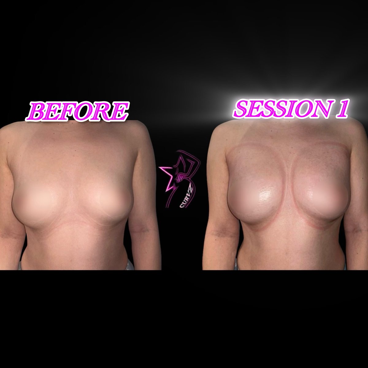 EXOTICMAMISNOW's tweet photo. Non-Invasive Breast Lift Session 1 #breastlift #vacuumtherapy #losangeles #booknow #viral https://t.co/Bz6YLKaCb8