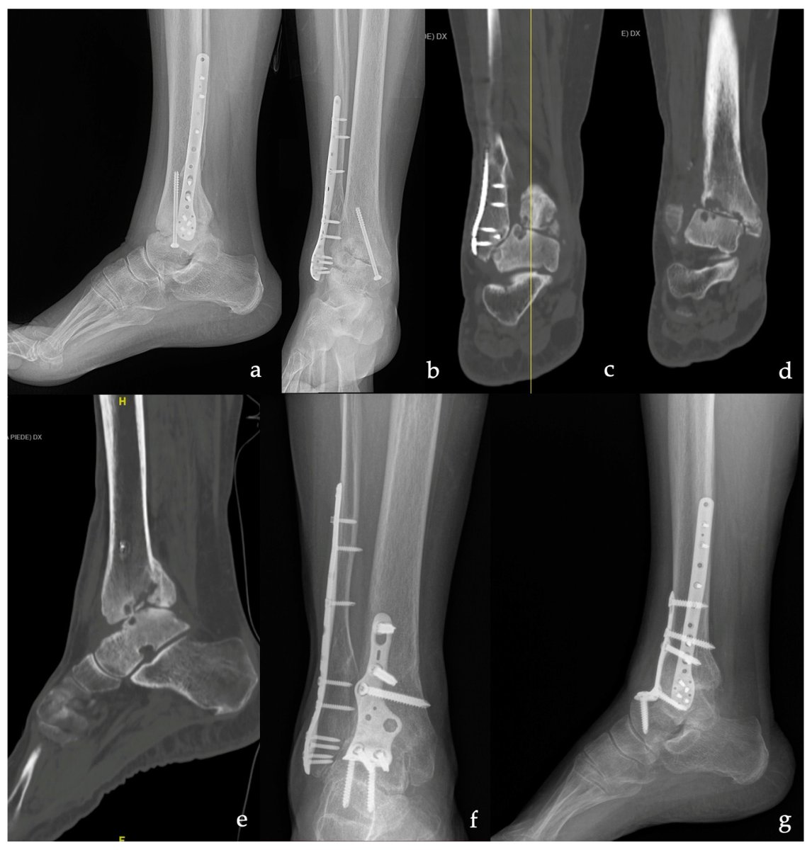 MdpiMedicina's tweet photo. #mdpimedicina #EditorChoicepaper
 📰 Tibiotalar and Tibiotalocalcaneal Arthrodesis with Paragon28 SilverbackTM Plating System in Patients with Severe Ankle and Hindfoot Deformity
 👍Citations 13
 ✍By Dr. Carlo Perisano, Dr. Tommaso Greco et al.
https://t.co/XdXog7DLnh https://t.co/Az9jXD7m7t