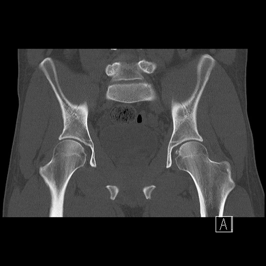 The anterior shuck test of the hip evaluates for anterior hip instability and ligamentum teres tears! Click/follow to learn more!

Watch: youtube.com/watch?v=OkY1BP…

Read: wikism.org/Anterior_Shuck…

#sportsmed #sportsmedicine #medicine #sports #foamSM #MedEd #FOAMed #ortho #medtwitter