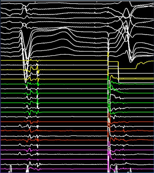 EhdaieMd's tweet photo. This epicardial #ablateVT put on a show for us! ๐
โRV PES no induction ๐
โ
LOB PES induction ala AVNRT ๐ฅ
โ
EGM-EGM predicts QRS-QRS ๐ฅ
#EGMsFirst #BeautifulEP #CedarsSinaiEP https://t.co/hAgtsA8p11