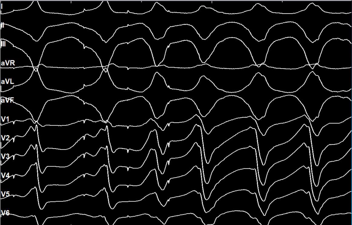EhdaieMd's tweet photo. This epicardial #ablateVT put on a show for us! ๐
โRV PES no induction ๐
โ
LOB PES induction ala AVNRT ๐ฅ
โ
EGM-EGM predicts QRS-QRS ๐ฅ
#EGMsFirst #BeautifulEP #CedarsSinaiEP https://t.co/hAgtsA8p11