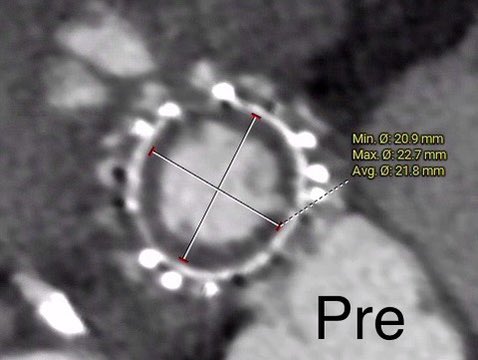 Dhoble7's tweet photo. TMVR ViV in prior 25 mm Epic valve, Fracking performed with 24 mm Balloon, expanding the valve reasonably well. @memorialhermann @UTHeartVascular https://t.co/6vwnq3gJDI
