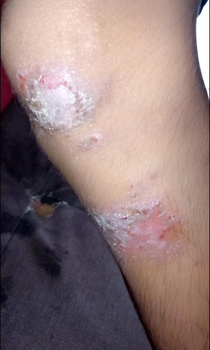 mcdc_mcdc's tweet image. Favor RP hasta que llegue a alguien en capacidad de ayudar🙏🏼

Fernando(13 años #linfoma) ha desarrollado queratosis por su tratamiento y necesita adecuar un dormitorio en casa solo para él con aire acondicionado. Mamá pide ayuda. 
Vive en Flor de Bastión 
☎️0984692966 #Gye
