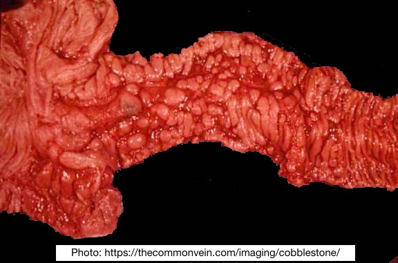 🤔  What is the finding below of terminal ileum?

🤔  What does this patient most likely have?

#pathX #gipath #pathology