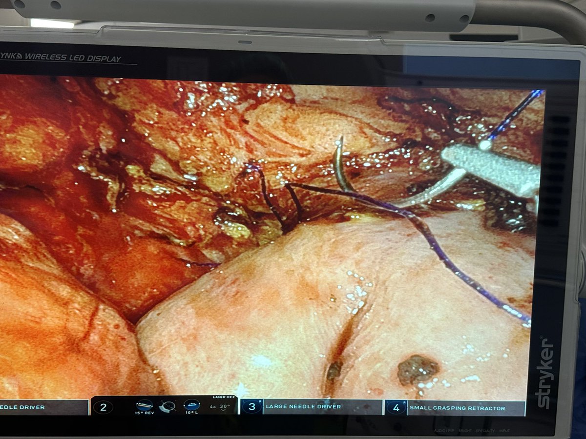 Another Robotic Whipple procedure for pancreatic uncinate cancer with fellows participating in the resection and reconstruction part of this operation. Robotic surgery leads to improved hands-on understanding and learning of this complex operation.

Robotic complex HPB surgery