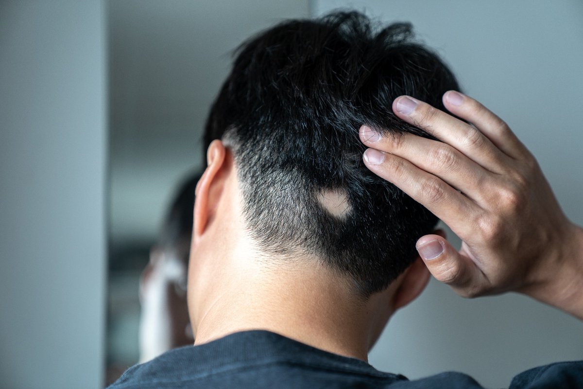 News Medical (@newsmedical) on Twitter photo Could a mood-boosting neurotransmitter unlock the next breakthrough in hair regrowth? New research reveals how serotonin activates key hair follicle cells, paving the way for novel hair loss therapies. news-medical.net/news/20250709/… <a href="/SciReports/">Scientific Reports</a> Could a mood-boosting neurotransmitter unlock the next breakthrough in hair regrowth? New research reveals how serotonin activates key hair follicle cells, paving the way for novel hair loss therapies. news-medical.net/news/20250709/… <a href="/SciReports/">Scientific Reports</a>