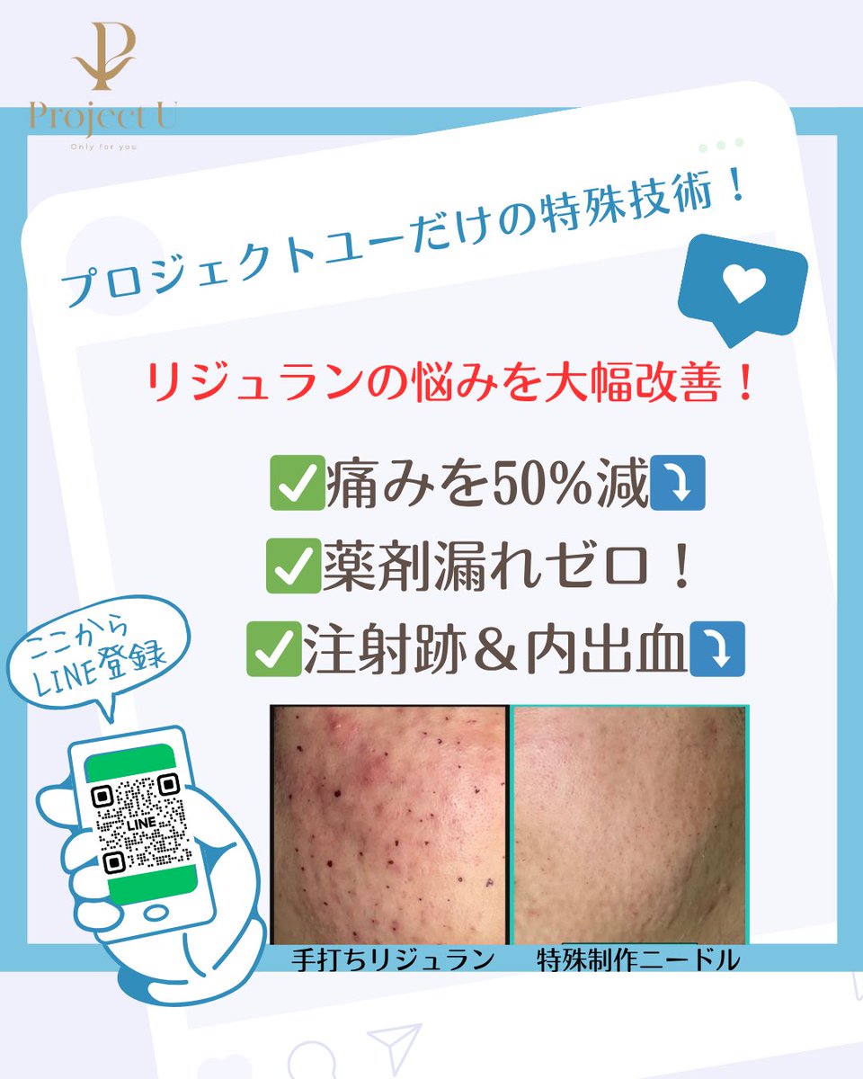 リジュラン(経験者)モニターさん大募集‼️
応募要項をご確認の上、本投稿コメント欄に申し込みして下さい🧡
~7/25までの募集になります！
当選は直接ご本人のアカウントにdmでお知らせしますので、必ずプロジェクトユーアカウントをフォローして下さいね☺️