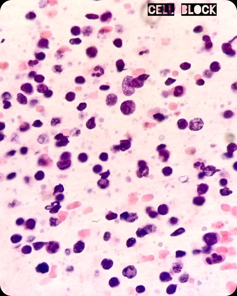 🦀 Medical record: B Cell lymphoma.
🖥️ Right genian lesion.  Irregular borders. Hypo / anechoic.
💉 Ultrasound guided fine needle aspiration performed by Interventional Pathologist.
2️⃣ Passes.  25g. 2.5cm.
🔬 Lymphoma relapse.  Flow cytometry ➕.

#Cytology #CytoPath #PathX