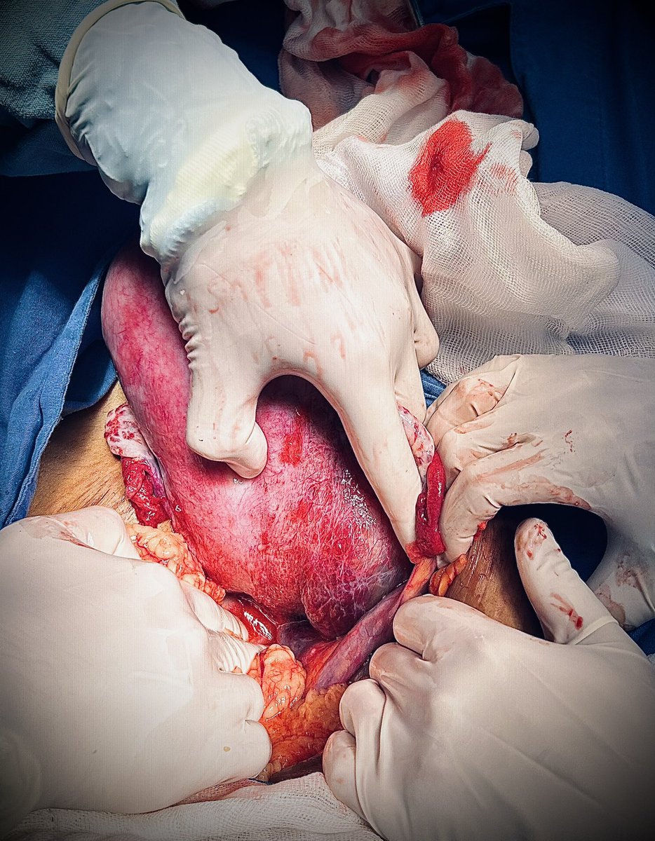 ArriagaMoises7's tweet photo. Px complicada por hemorragia obstétrica secundario a Atonía uterina y hematoma disecante vaginal post parto el cual compromete ligamento ancho.
Tx: Drenaje de hematoma + ligadura de arterias hipogastricas + sutura compresiva tipo Hayman. 

🤰⚕️ https://t.co/2xwok2g7qA