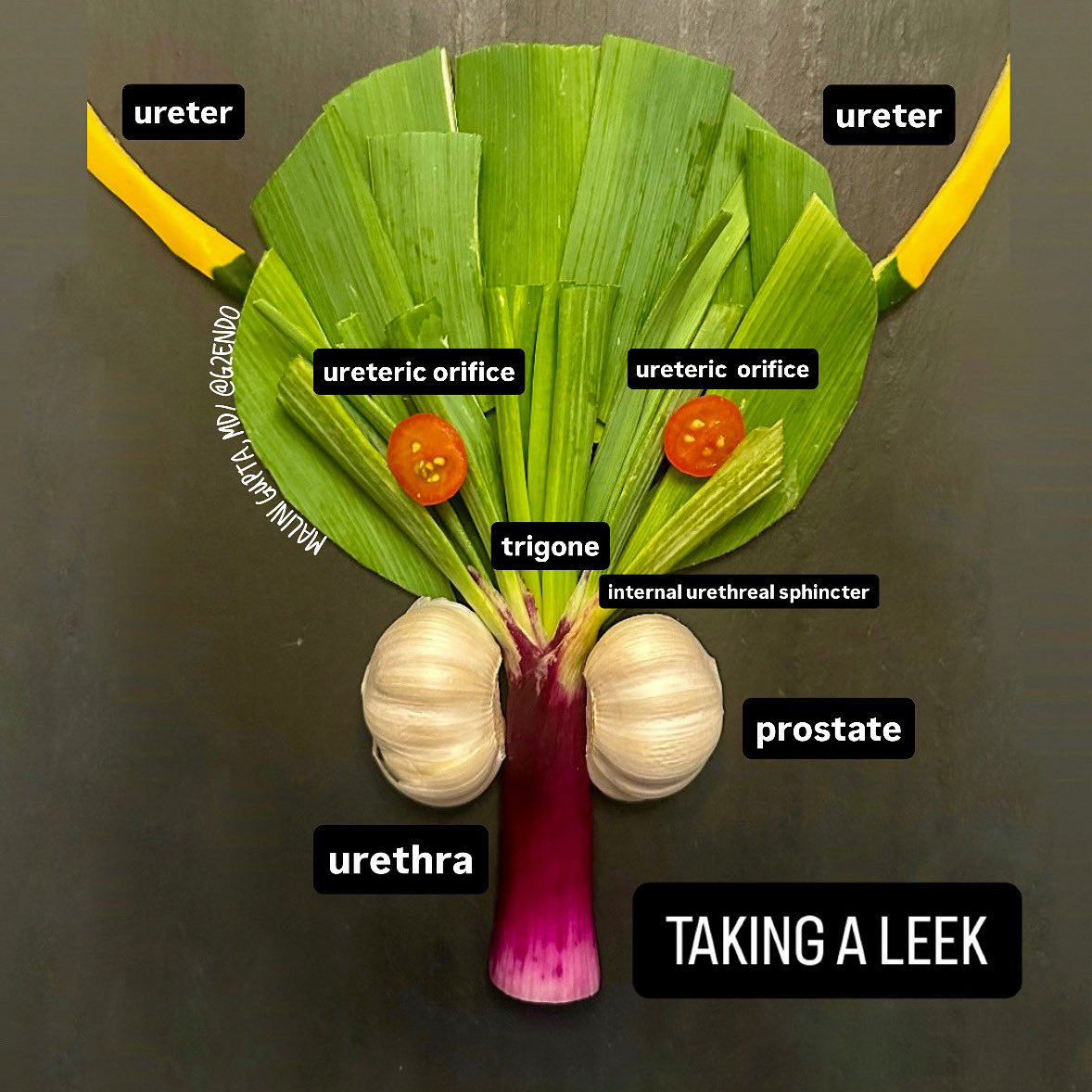 Malini Gupta, MD, FACE, ECNU (@maliniguptamd) on Twitter photo Diet plays a role in pain in overactive bladder. Onions can exacerbate the pain, whereas milder leeks are well-tolerated.  I made this piece from leek, garlic, and a few other vegetables. Diet plays a role in pain in overactive bladder. Onions can exacerbate the pain, whereas milder leeks are well-tolerated.  I made this piece from leek, garlic, and a few other vegetables.