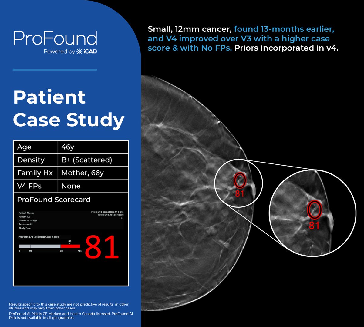 [#iCADPatientStudy] See how this patient would have benefited from ProFound Detection V4. Her small, 12mm cancer would have been found 13-months earlier with an higher case score from incorporating her prior exam, when treatment options were better.

bit.ly/3T5LBn3