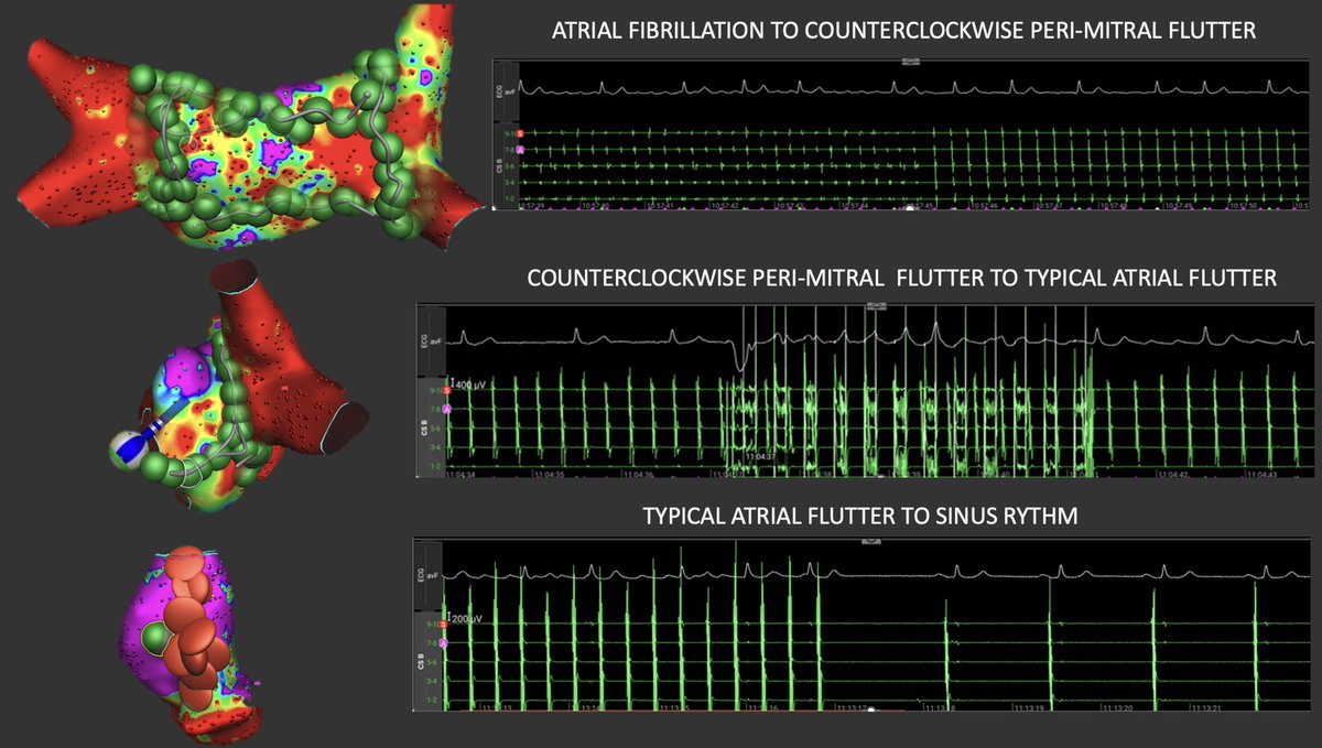 Konstantinos Letsas (@k_letsas) on Twitter photo Pers AF ablation case with AFFERA system leaving the lab in SR.
<a href="/A_Martinos/">Martinos Antonis</a> <a href="/koskinastavrina/">Stavrina Koskina</a>
<a href="/ipetemil/">Panagiotis Mililis</a> <a href="/athsaplaouras/">Athanasios Saplaouras</a> <a href="/SteliosDragasis/">Stelios</a>
<a href="/MEfraimidis/">Michail Efremidis</a> <a href="/PetrosSkalidis/">Petros Skalidis</a> <a href="/Medtronic/">Medtronic</a>
#Onassis Hospital Pers AF ablation case with AFFERA system leaving the lab in SR.
<a href="/A_Martinos/">Martinos Antonis</a> <a href="/koskinastavrina/">Stavrina Koskina</a>
<a href="/ipetemil/">Panagiotis Mililis</a> <a href="/athsaplaouras/">Athanasios Saplaouras</a> <a href="/SteliosDragasis/">Stelios</a>
<a href="/MEfraimidis/">Michail Efremidis</a> <a href="/PetrosSkalidis/">Petros Skalidis</a> <a href="/Medtronic/">Medtronic</a>
#Onassis Hospital