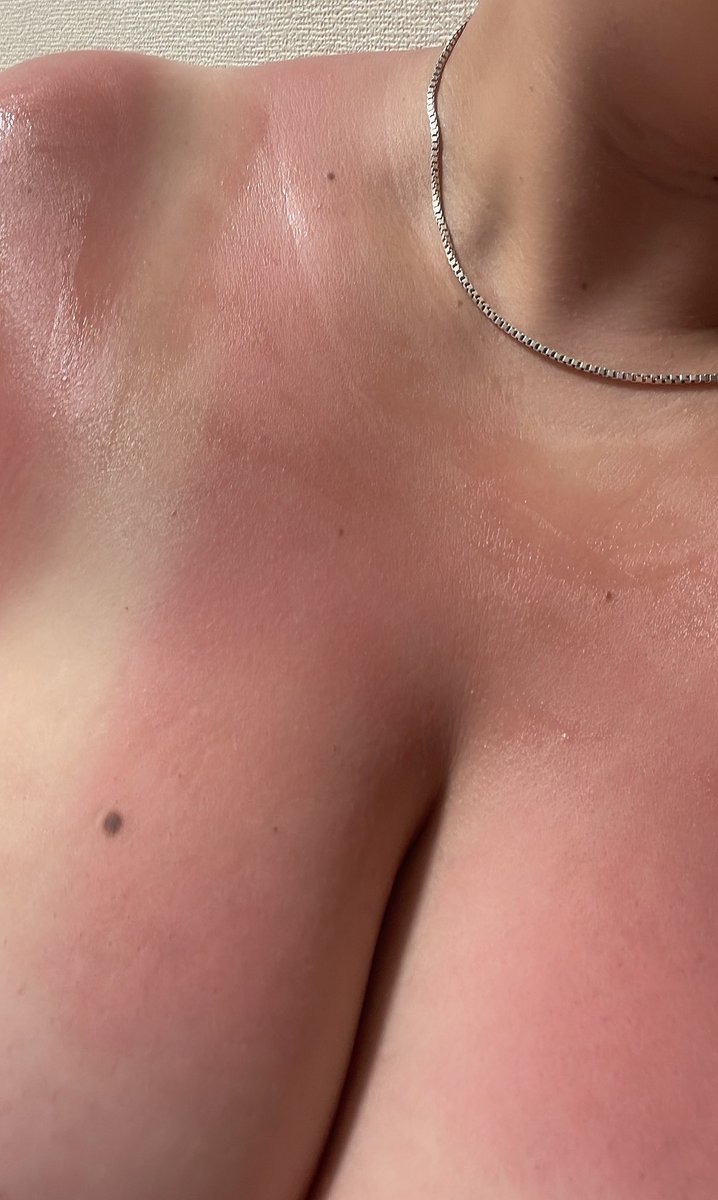そんな焼けたつもりなかったのに😭
いーたーいー😭
今年もくっきり水着跡のこりそうw