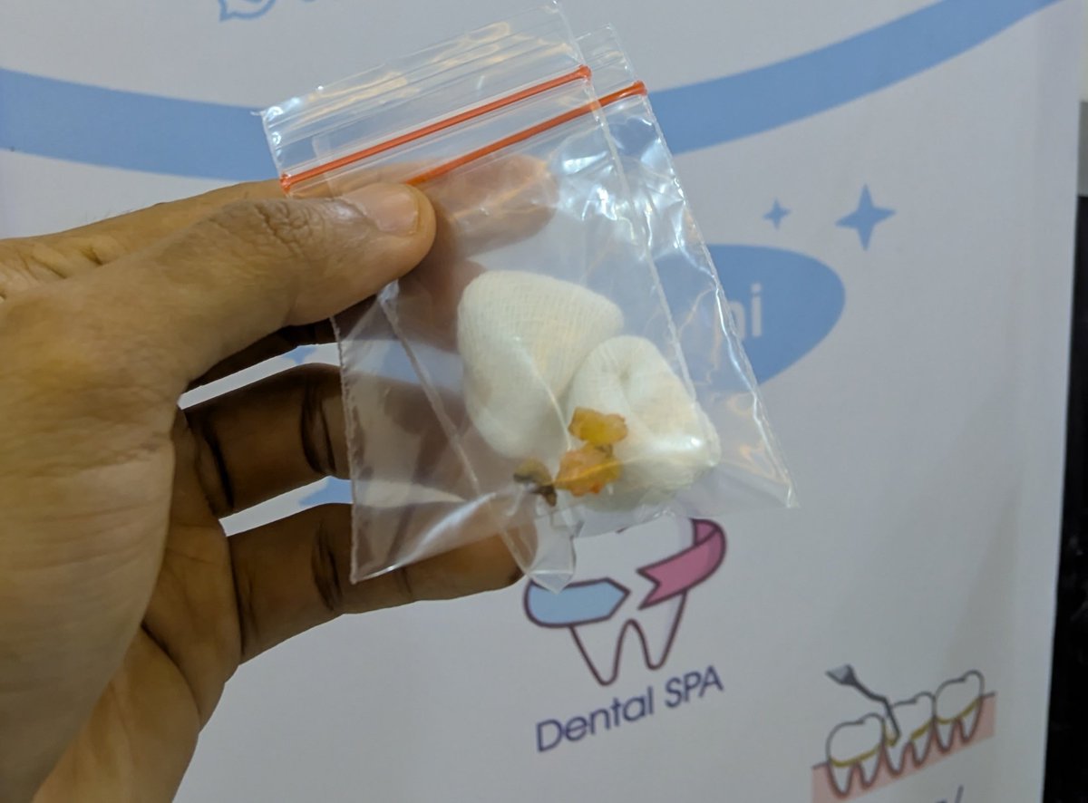 Mencabut pelaku yg nyerinya nyiksa banget + yg bikin badan demam terus2an dari sebelum race vfm kemaren.