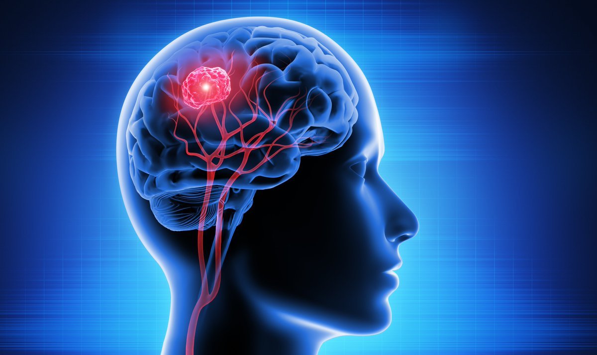 Scientists at the Yale Systems Biology Institute and the Mayo Clinic have revealed clues about the spread of brain #cancer – and the potential to improve life expectancy predications and therapeutic treatments: bit.ly/Yale-Mayo