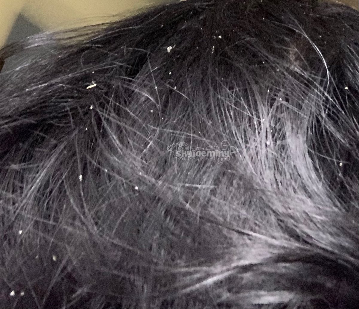 ✨hair treatment untuk rambut berminyak dan berketombe✨

⚠️maaf kalo jijik karena ini sharing pengalaman ajaa yaaa

jujur rambut ketombe dan minyakan tuh nyebelin banget menurutku, karena selain gatel-gatel, apek jadinyaaa kayak beneran gak sehat banget dah🤦‍♀️