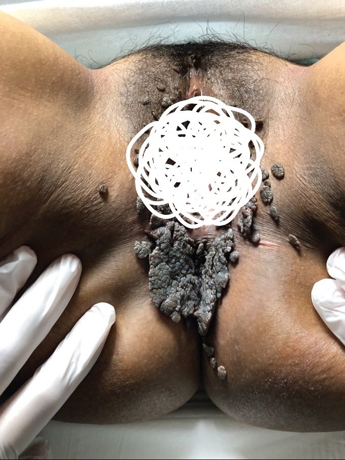 Genital warts.