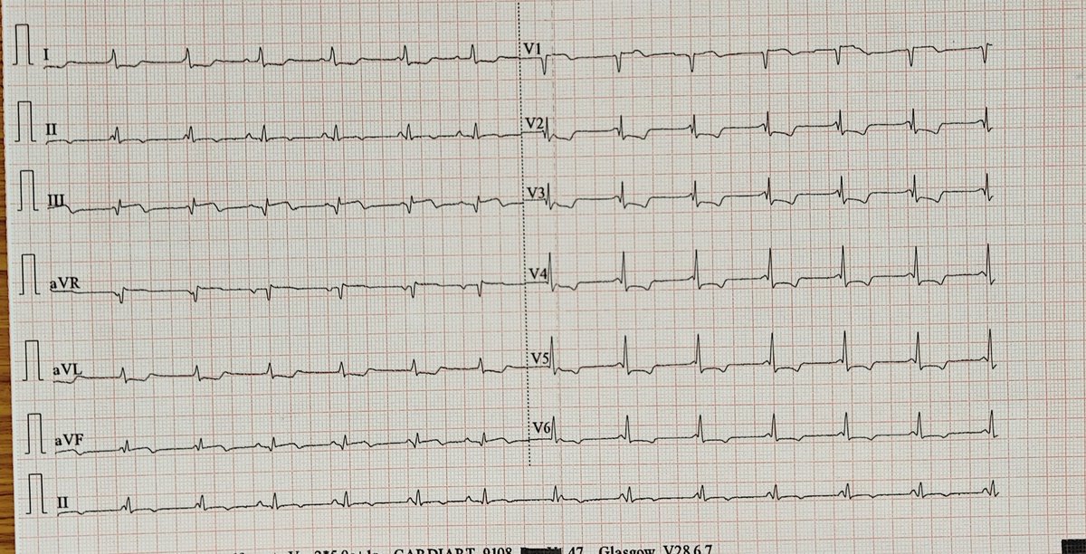 praneet_manekar's tweet image. Patient underwent primary PCI to RCA in view of IW+RVMI with CHB. He was kept on TPI backup and on day 2 this was the ECG. What is the rhythm?
#ecg #cardiotwitter #pci #arrythmias