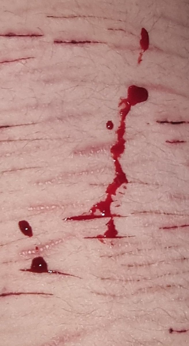 Autoreactivity's tweet photo. This shit drippeddd
#shtwt #slitwt #styros #blooddrip #selfharms #shedtwt https://t.co/vccbwbBjgs