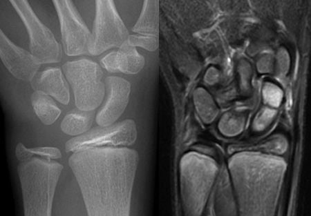 TRAUMA X-RAY 38: Trauma to wrist. What are these images? Why did this patient need the investigation on the right? Answer buff.ly/3WpmWM8
