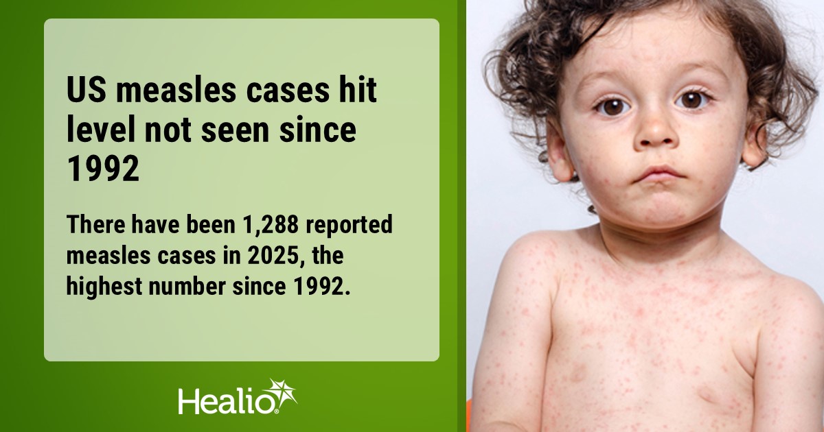 IDinChildren's tweet image. 📈 The CDC is reporting 1,288 #measles cases as of today, officially surpassing the number of cases in 2019.
This is the highest number in 1 year since 1992 – 8 years before measles was eliminated from the U.S.
healio.com/news/pediatric…
#pediatrics #IDTwitter @InfectDisNews