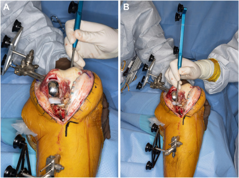 SURGICAL TECHNIQUE: Robotic-Assisted Conversion of Unicompartmental Knee Arthroplasty to Total Knee Arthroplasty

Robotic assistance can aid in bone preservation and alignment in conversion UKA to TKA.  Technique and review: 
arthroplastytoday.org/article/S2352-…