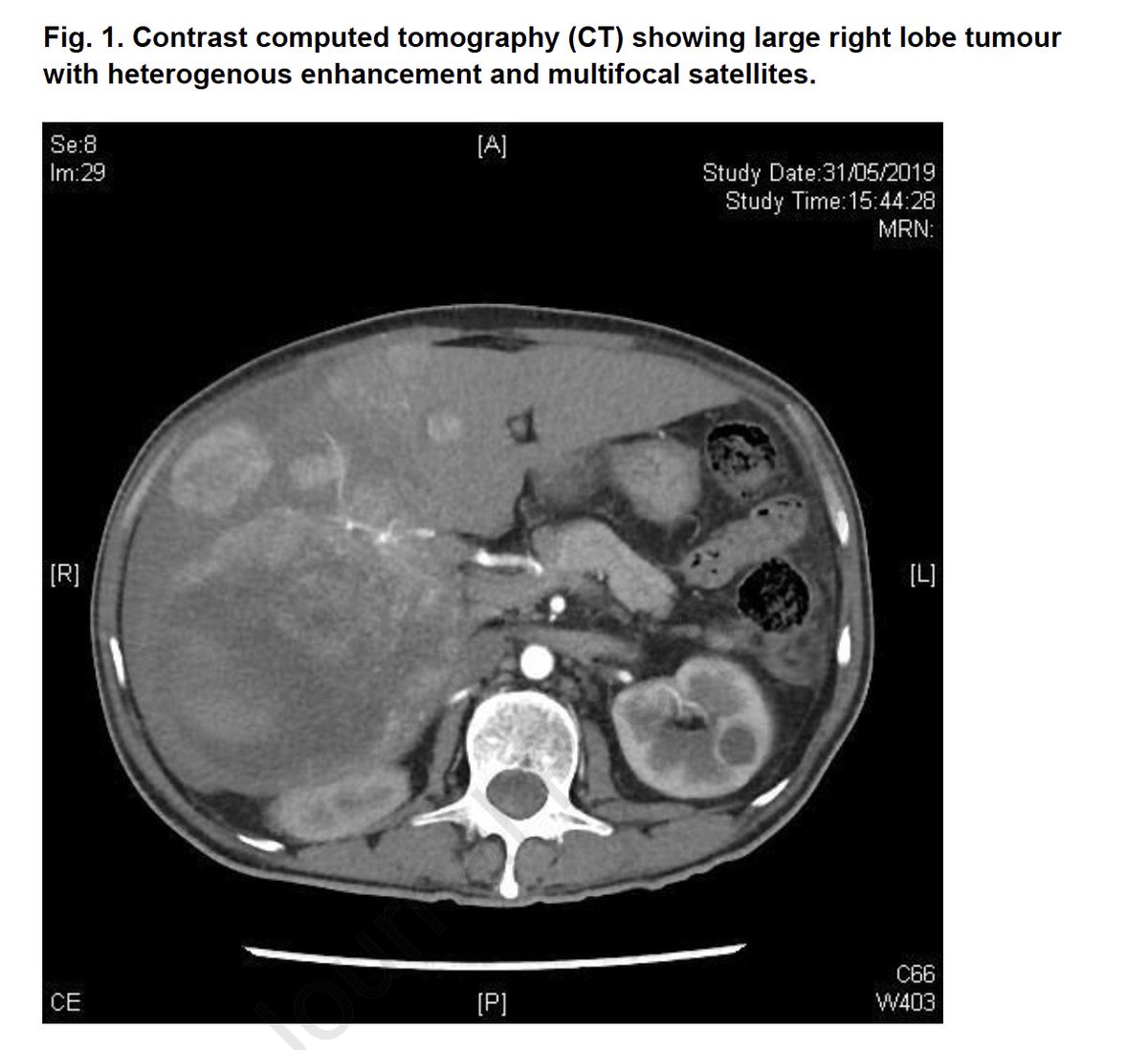 Arndt Vogel (@arndtvogel) on Twitter photo Fulminant Tumour Lysis Syndrome after Nivolumab and Ipilimumab treatment for Hepatocellular Carcinoma
<a href="/JHepatology/">Journal of Hepatology</a>
doi.org/10.1016/j.jhep…
🧐New problems with more effective systemic therapies in HCC❗️
<a href="/myESMO/">ESMO - Eur. Oncology</a> <a href="/EASLedu/">EASL Education</a> <a href="/ILCAnews/">ILCA</a> Fulminant Tumour Lysis Syndrome after Nivolumab and Ipilimumab treatment for Hepatocellular Carcinoma
<a href="/JHepatology/">Journal of Hepatology</a>
doi.org/10.1016/j.jhep…
🧐New problems with more effective systemic therapies in HCC❗️
<a href="/myESMO/">ESMO - Eur. Oncology</a> <a href="/EASLedu/">EASL Education</a> <a href="/ILCAnews/">ILCA</a>