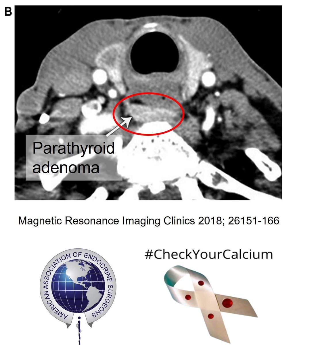 4D Parathyroid CT is one of the most sensitive scans for spotting overactive parathyroid glands—especially when multiple glands are involved or in unusual locations other tests might miss.

But remember, primary hyperparathyroidism is diagnosed by blood tests—not scans.
#PAM2025