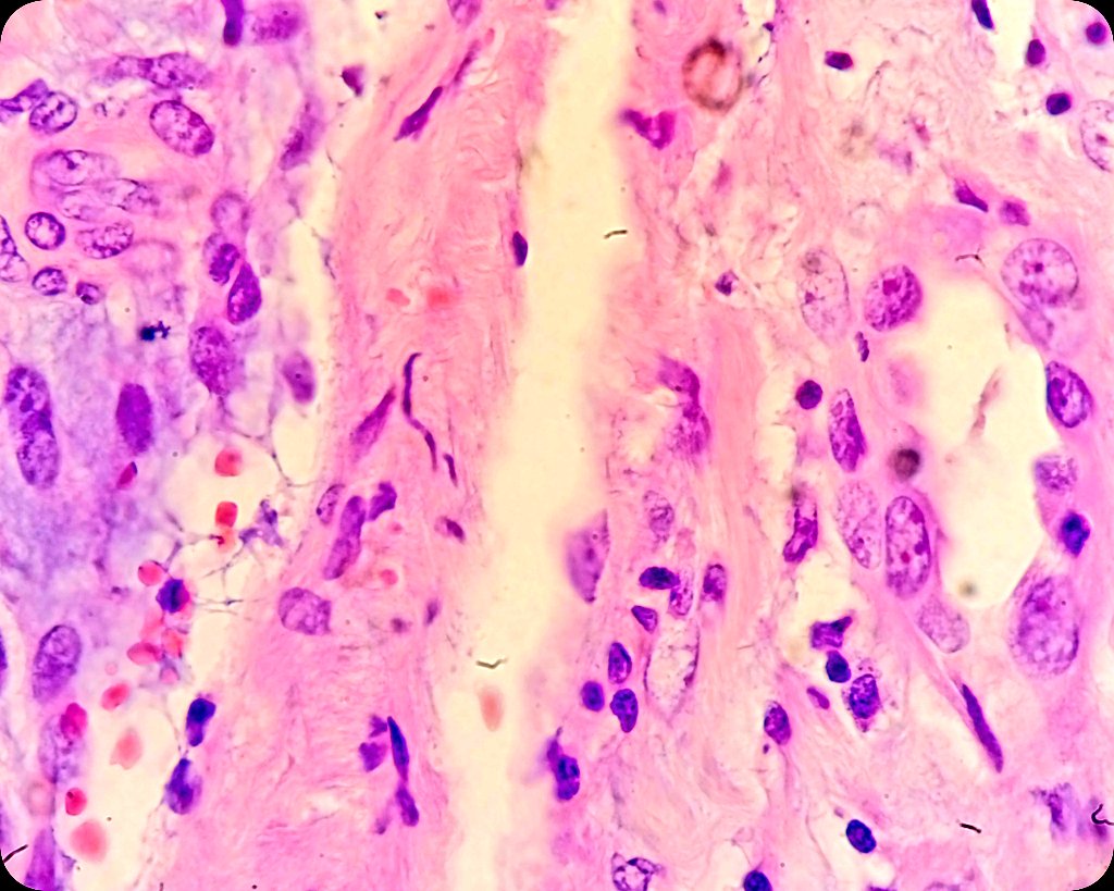 🫁 Lung Adenocarcinoma.
🔬 Real Arterial Invasion (tumor endothelialization) ➕ Perineural Invasion.

#LungCancer #LungPath #PulmPath #PathX