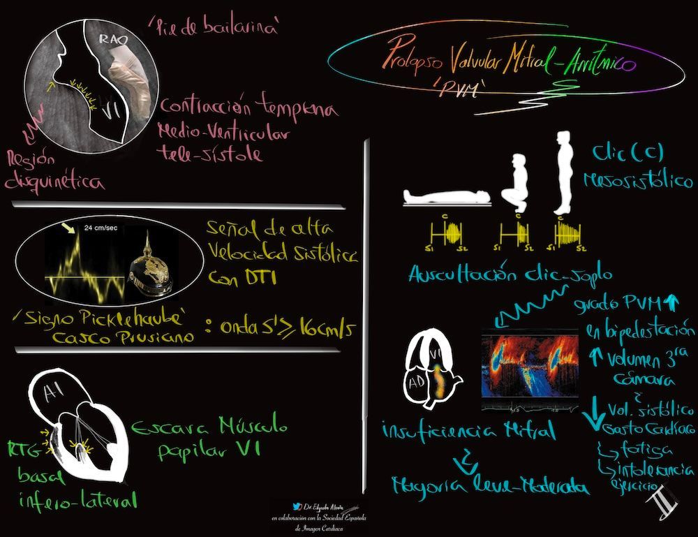 Prolapso valvular mitral arrítmico (2)
📊 buff.ly/jIhY1UG ◀️
Gran resolución ⤴️ en la web
Repaso de las Infografías creadas por Edgardo Alania