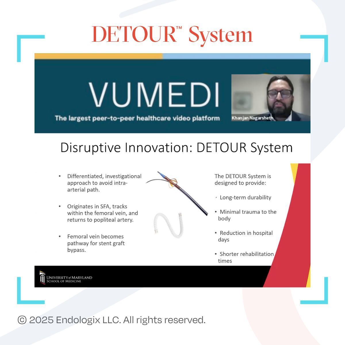 Endologix (@endologix) on Twitter photo As part of the <a href="/VuMedi/">VuMedi</a> Lecture Series, <a href="/KNagarshethMD/">KJ Nagarsheth MD, MBA, FACS</a> of <a href="/UMmedschool/">University of Maryland School of Medicine</a> discusses the #DETOURSystem, a "disruptive innovation" that can fill a significant treatment gap for patients with severe, long fem-pop lesions. Hear from Dr. Nagarsheth: vumedi.com/lecture-series…
ISI: As part of the <a href="/VuMedi/">VuMedi</a> Lecture Series, <a href="/KNagarshethMD/">KJ Nagarsheth MD, MBA, FACS</a> of <a href="/UMmedschool/">University of Maryland School of Medicine</a> discusses the #DETOURSystem, a "disruptive innovation" that can fill a significant treatment gap for patients with severe, long fem-pop lesions. Hear from Dr. Nagarsheth: vumedi.com/lecture-series…
ISI: