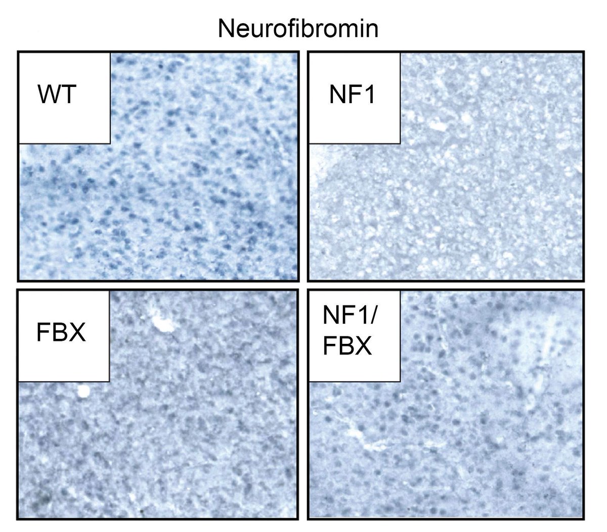 the_asci's tweet image. A novel way to restore neurofibromin levels in Neurofibromatosis type 1—
ASCI member @wade_clapp & team @IndianaUniv demonstrate correction of neurobehavioral deficits in a preclinical NF1 model: jci.org/articles/view/…