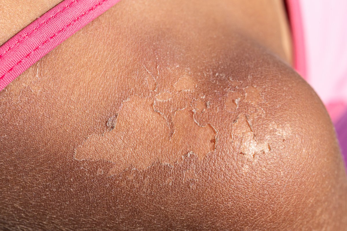 Summer has arrived, and we will all be spending more time outdoors. However, spending more time outdoors increases the risk of encountering common summer skin problems. Here are some common skin problems and how to prevent them.
jamaicahospital.org/newsletter/com…
#CommonSummerSkinProblems