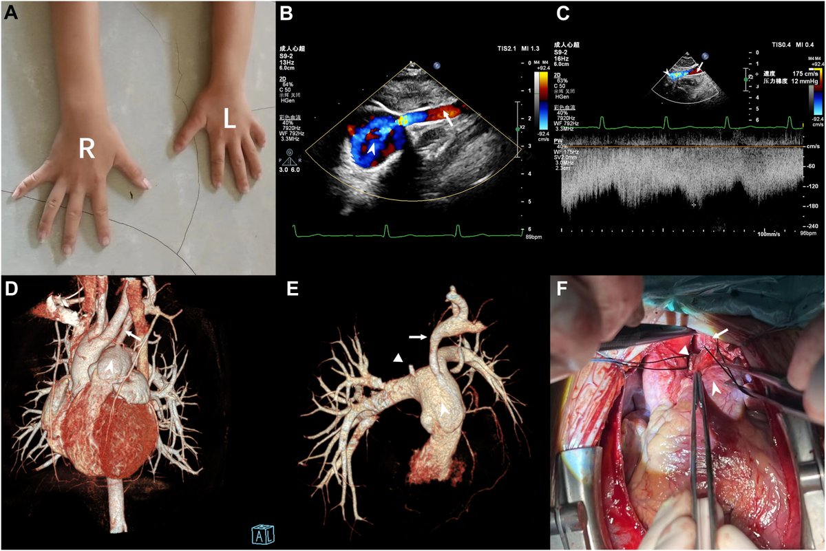 ❗ Rare case alert! An 8-year-old girl with delayed development presented with left upper limb hypoplasia + blood pressure discrepancy. Diagnosis: anomalous left subclavian artery origin from the pulmonary artery—seen in just 0.8% of right aortic arches. Read more ⬇️