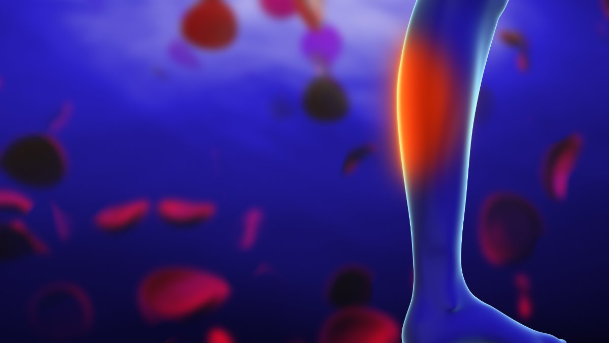 UniOfSurrey's tweet image. Quantitative waveform analysis with ultrasounds for earlier diagnosis and more effective management of peripheral artery disease (PAD) aka poor blood circulation to the legs and feet. bit.ly/450NNBV
@heissheissheiss @ESC_Journals @ESVM_
#HeartHealth #BloodCirculation…