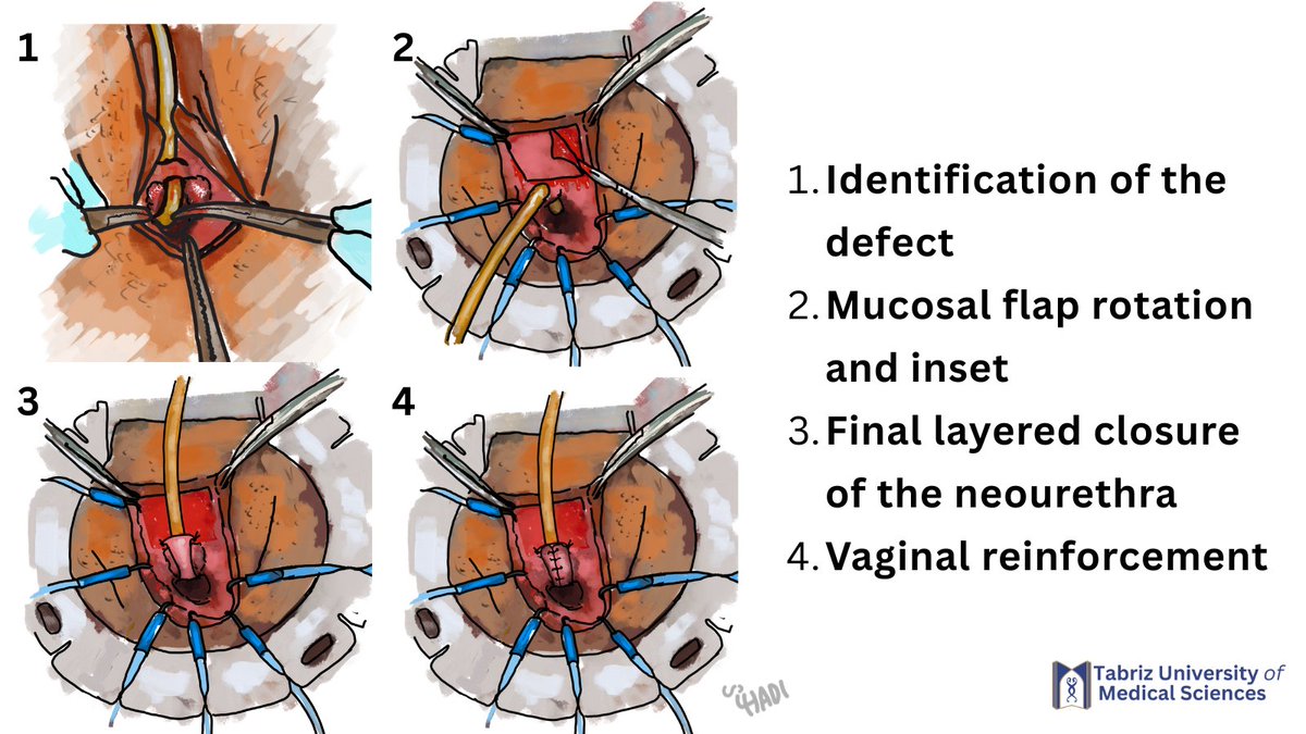 hadimostafaee's tweet photo. A challenging case of persistent UTI and vaginal discharge after a failed TOT explantation.
Huge urethral defect discovered intraop managed with vaginal mucosal flap reconstruction.
What is your approach?
Thanks to @HajebrahimiS @DrShariat 
#Urology #FemaleUrology #PelvicSurgery https://t.co/nligbFDhN8