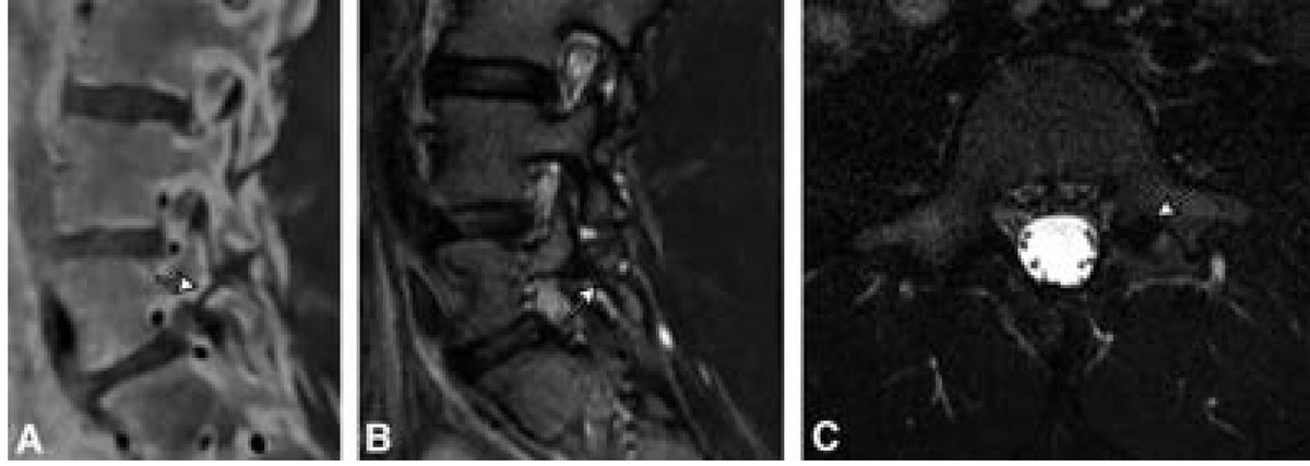 From the January-March 2025 Issue of #Neurographics: Imaging of Low Back Pain in Adolescents and Young Adults: Looking Beyond the Usual Suspects ow.ly/Jyf350VO3FB