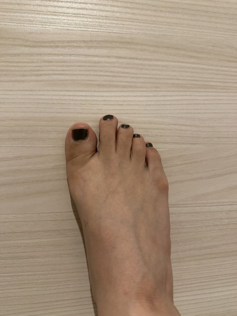 エスワンタイホウ
色素沈着経過観察13
2クール2日目

とくに副作用なし

#経口抗がん剤
#抗がん剤
#エスワンタイホウ
#色素沈着
#乳がん
#ルミナールb